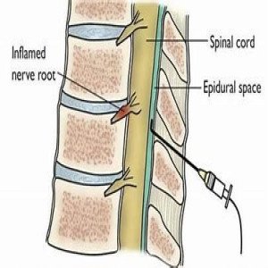 Intraspinal Injection